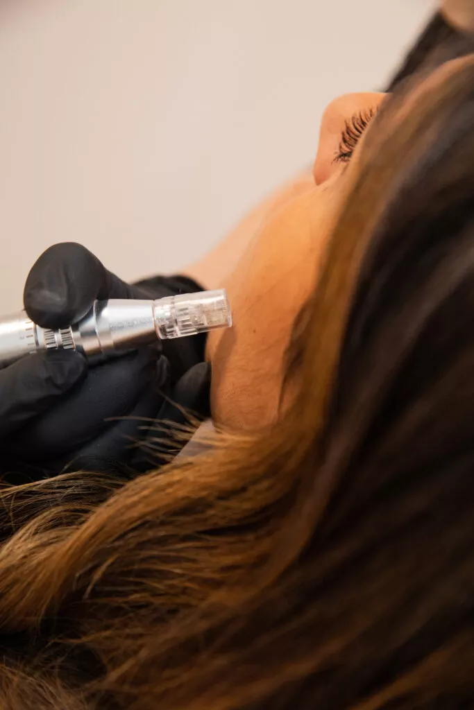 Microneedling à Marseille : notre clinique de médecine esthétique Beige Clinique à Marseille réalise votre microneedling personnalisé