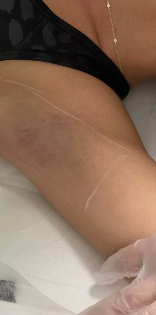 Optez pour une épilation définitive au laser chez Beige Clinique, clinique de médecine esthétique à Marseille spécialisée en épilation définitive laser et lumière pulsée