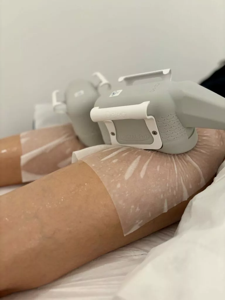 Cryolipolyse abdominale : dites adieu aux bourrelets sans chirurgie