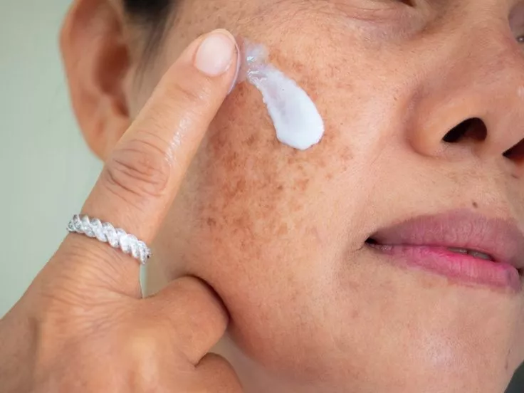 Hyperpigmentation : comment retrouver un teint unifié grâce à la médecine esthétique