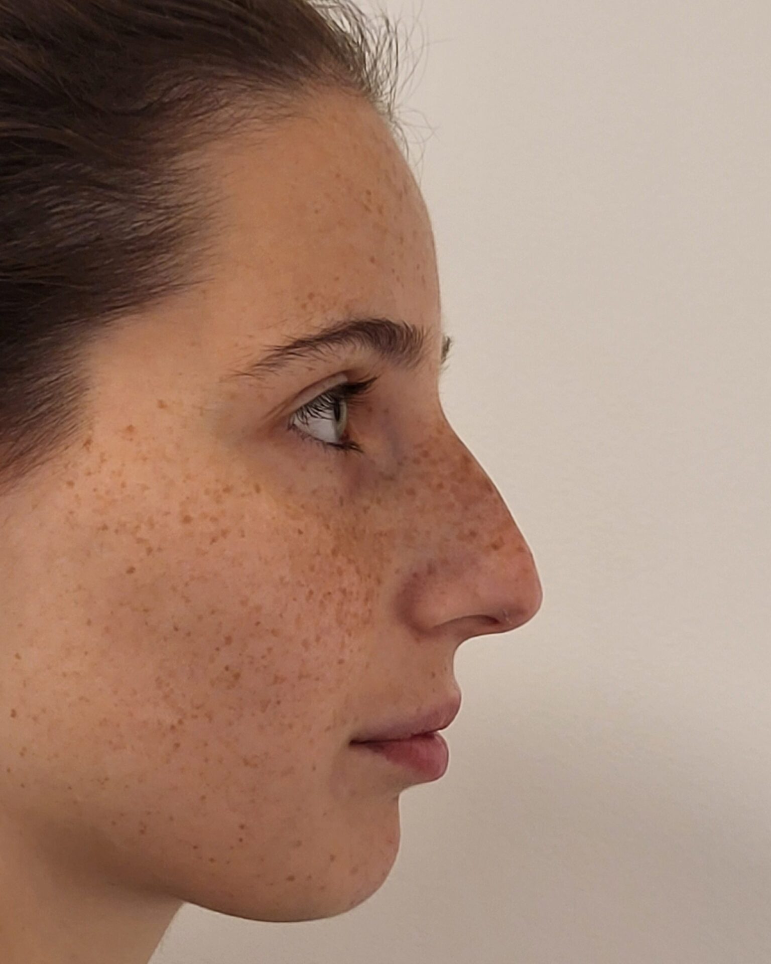 avant injections nez acide hyaluronique avant injections nez acide hyaluronique