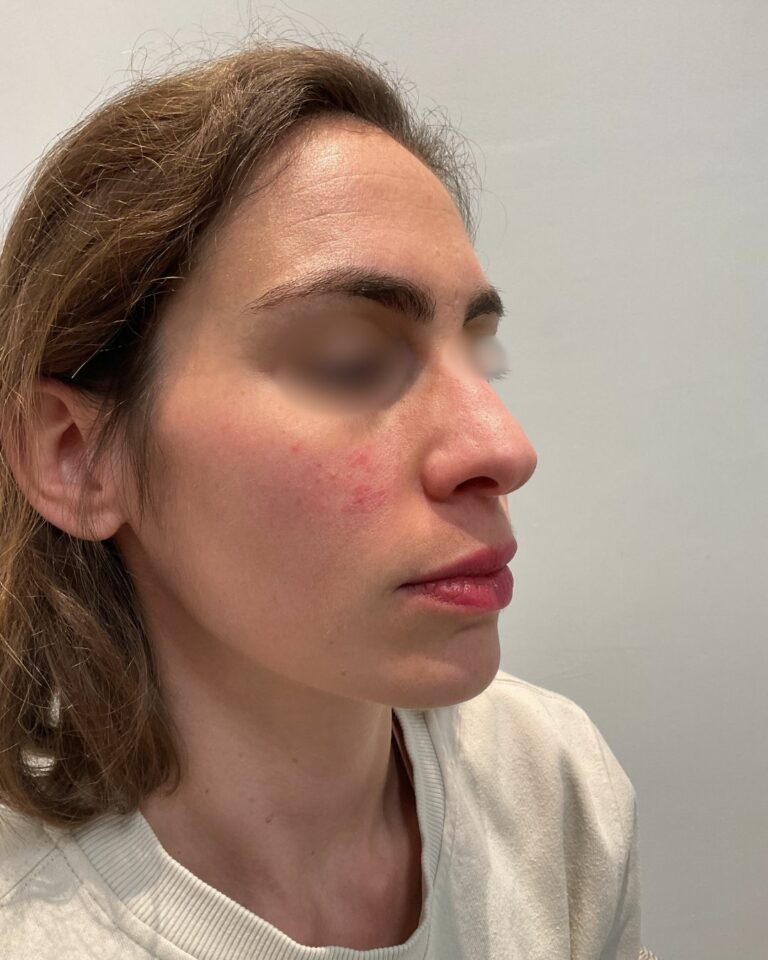 avant traitement microneedling