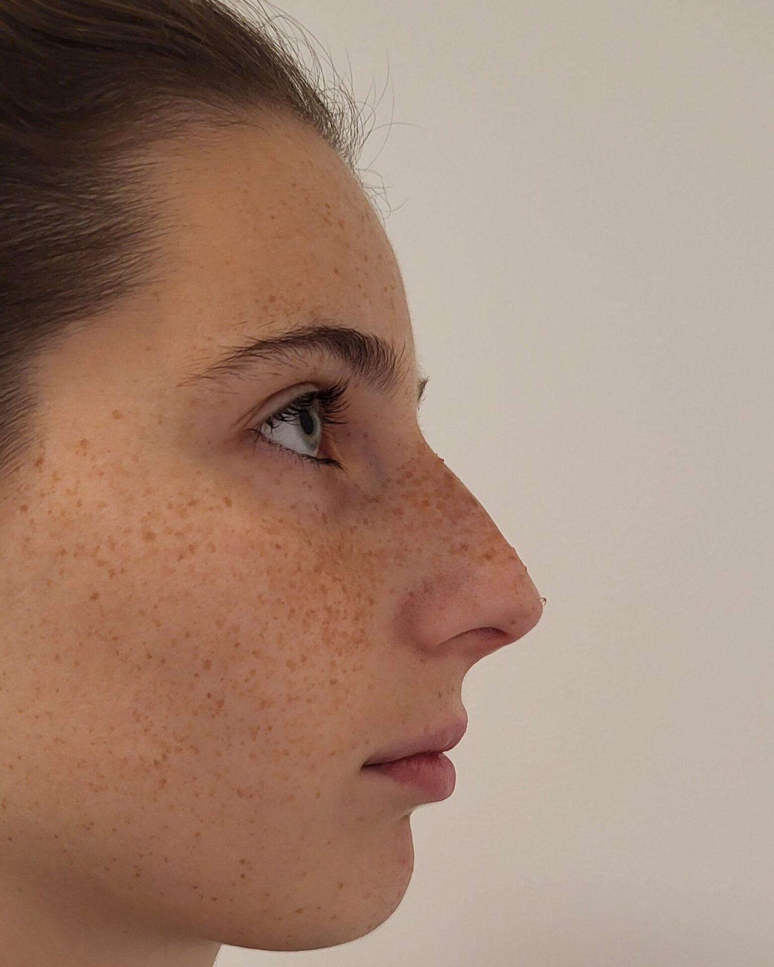 apres injections nez acide hyaluronique apres injections nez acide hyaluronique