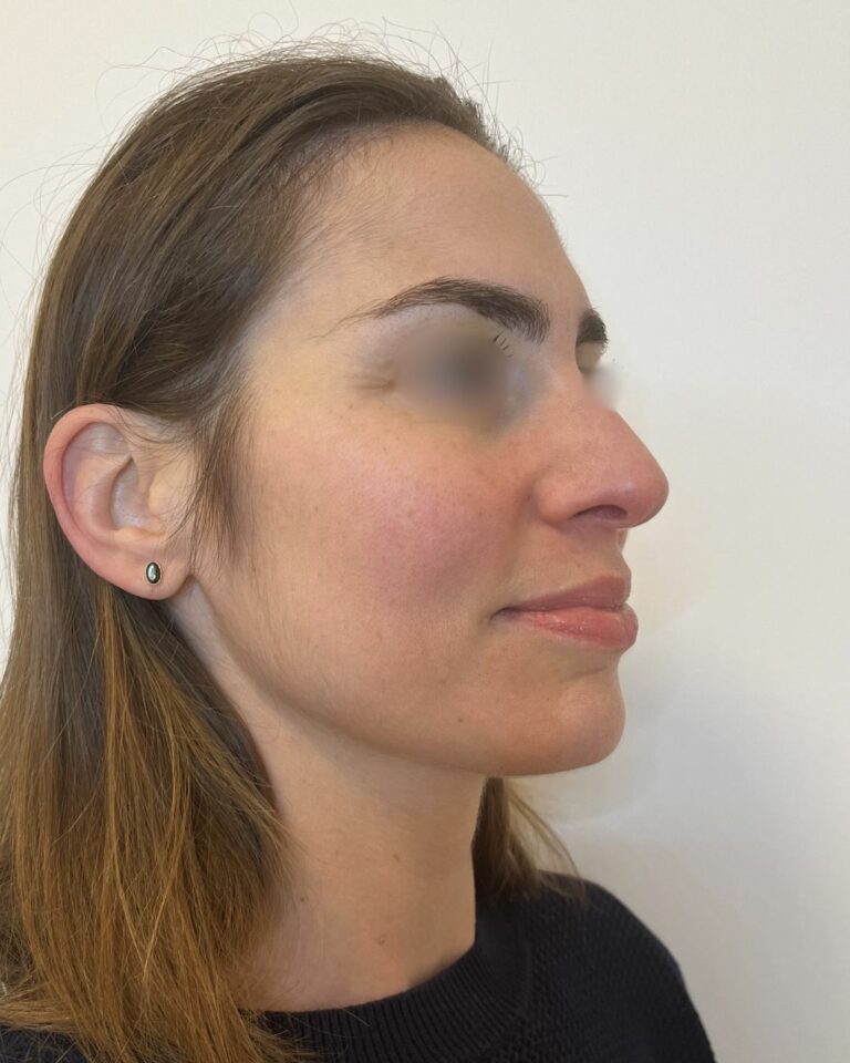 avant après traitement microneedling