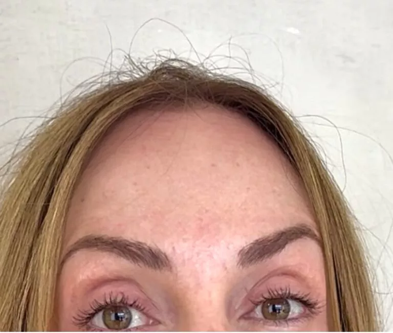 Après injection front botox