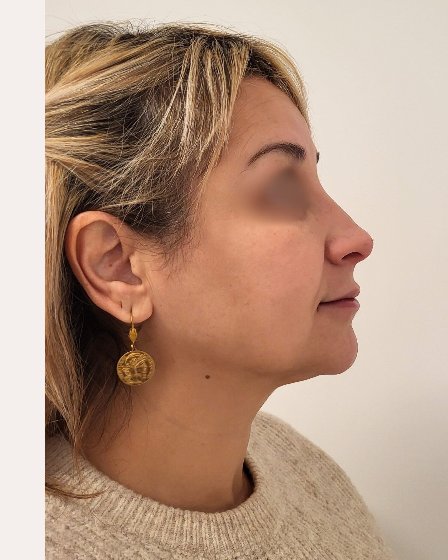 Après injection profiloplastie