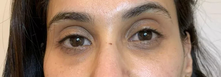Après peeling contour de l’oeil
