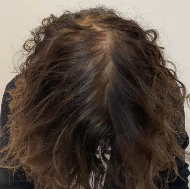 Après traitement prp capillaire