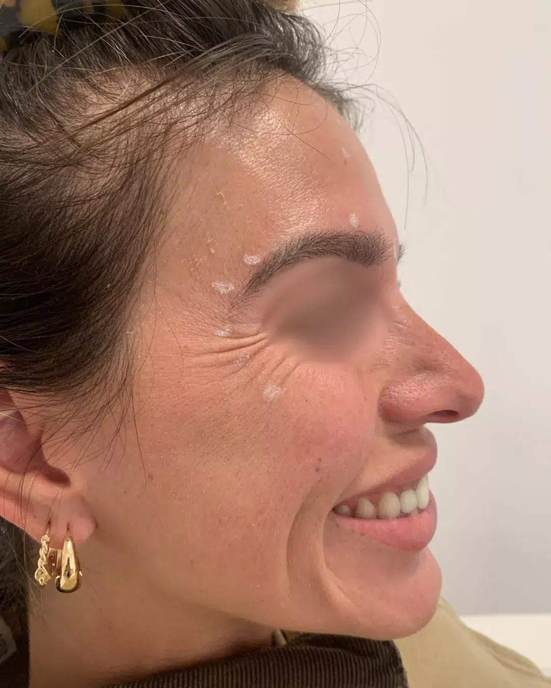 Avant injections pattes d’oie