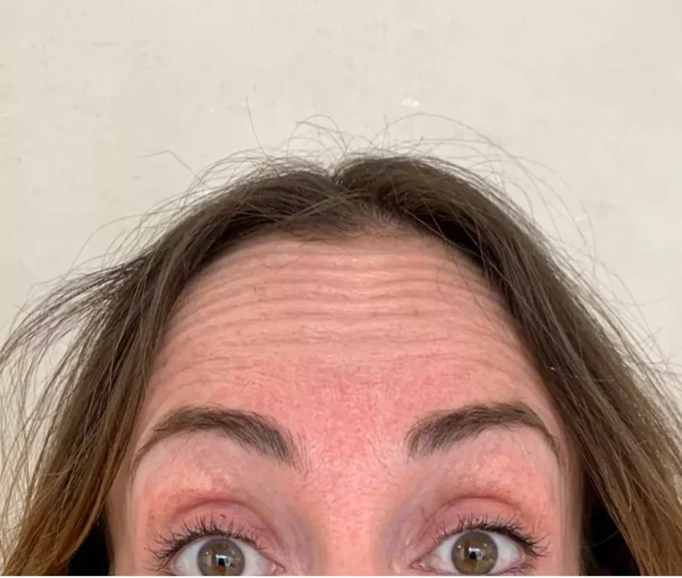 Avant injecton front botox