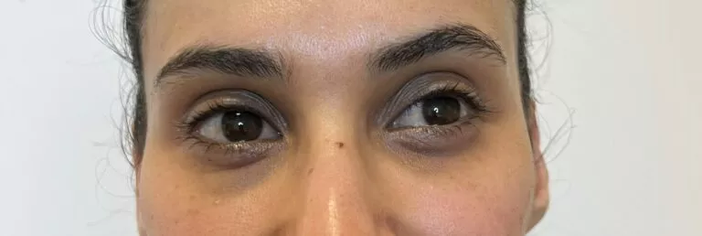 Avant peeling contour de l’oeil