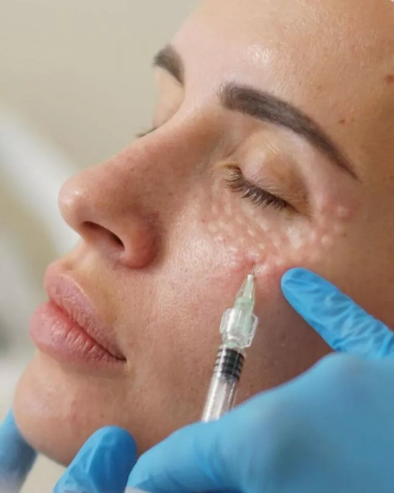 Skinboosters : le secret d’une peau éclatante et hydratée en profondeur à Marseille