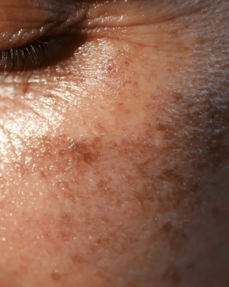 Les cicatrices d’acné et taches sur le visage : les traitements efficaces à découvrir chez Beige Clinique à Marseille