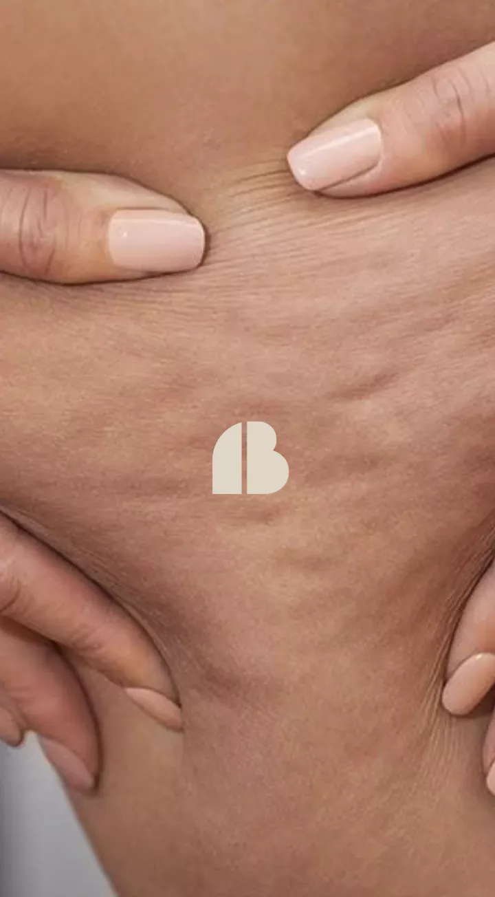 Comment traiter efficacement la cellulite : solutions esthétiques et résultats durables