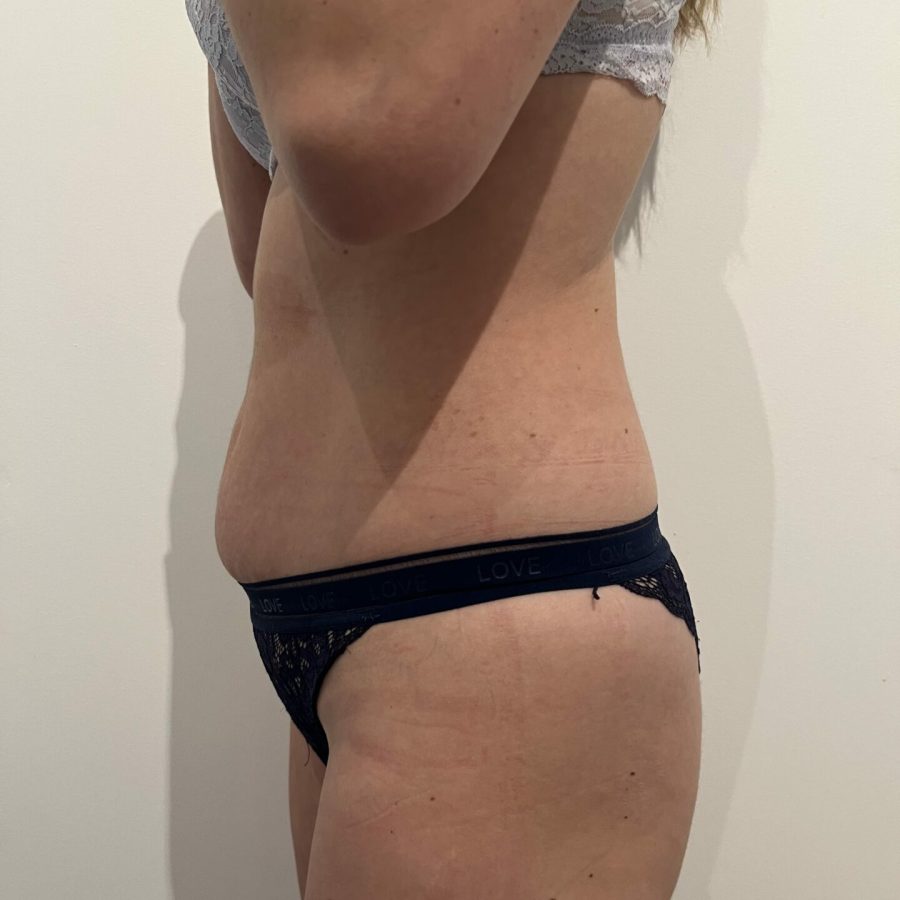 avant cryolipolyse profil Avant cryolipolyse profil